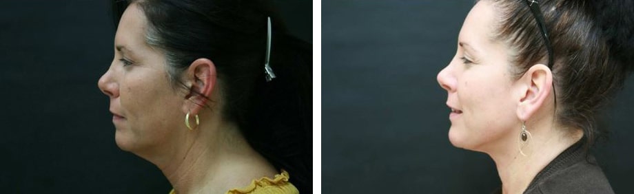 Before and After Image: Liposuction - left-side