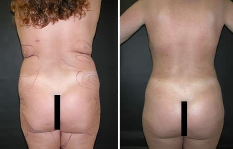 Before and After Image: Liposuction - back