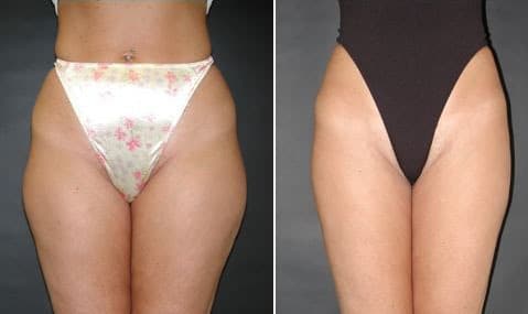 Before and After Image: Liposuction - front