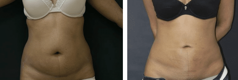 Before and After Image: Liposuction - front