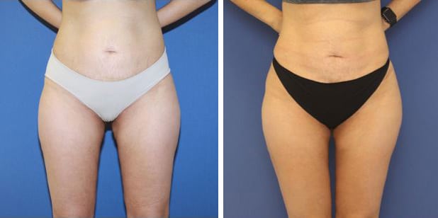 Before and After Image: Liposuction - front