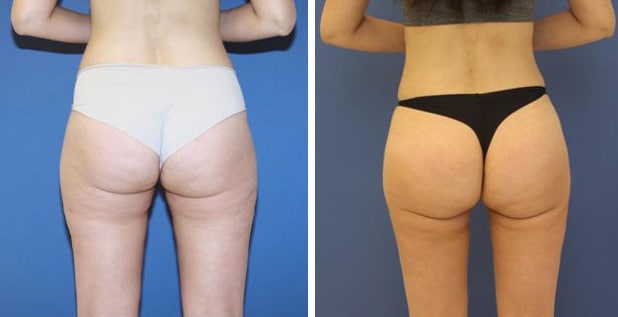 Before and After Image: Liposuction - back