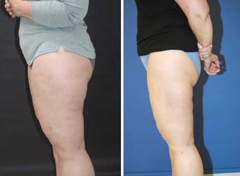 Before and After Image: Liposuction - left-side