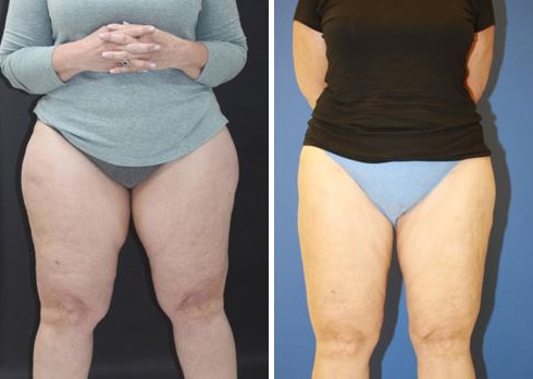 Before and After Image: Liposuction - front