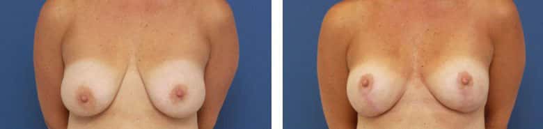 Before and After Image: Mastopexy - front
