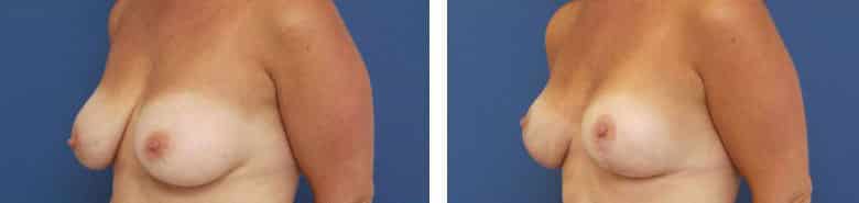 Before and After Image: Mastopexy - left-front-oblique