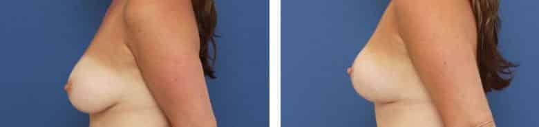 Before and After Image: Mastopexy - left-side