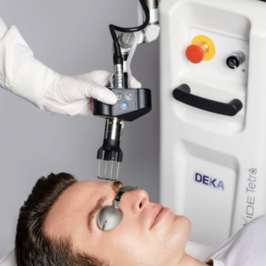 Deka C02 Laser Treatment